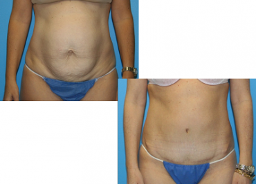 cirugia estética realizada de Abdominoplastia